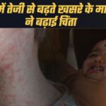 मध्यप्रदेश से बड़ी खबर… राज्य में तेजी से बढ़ रहे हैं खसरे के मरीज, और बच्चों की सुरक्षा को लेकर हाई अलर्ट जारी किया गया है।
